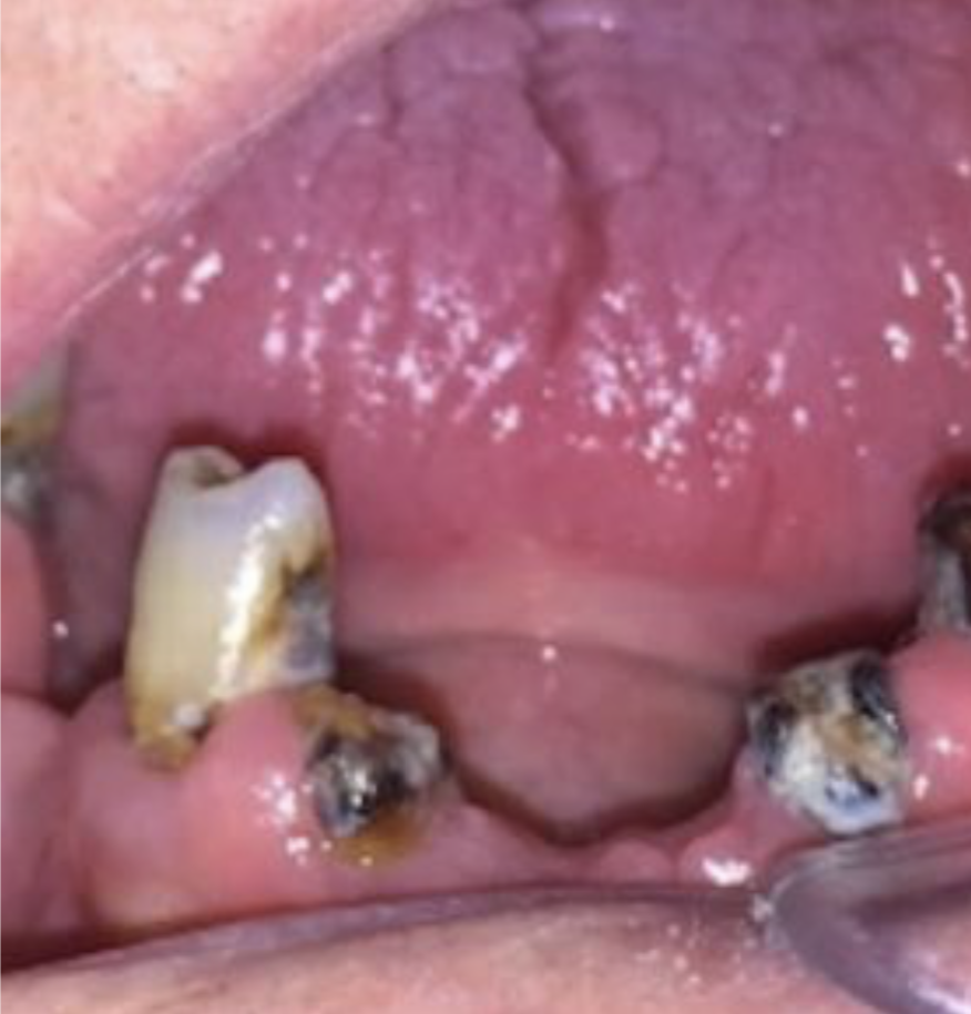 Radiotherapy Damage to Teeth & Jaws