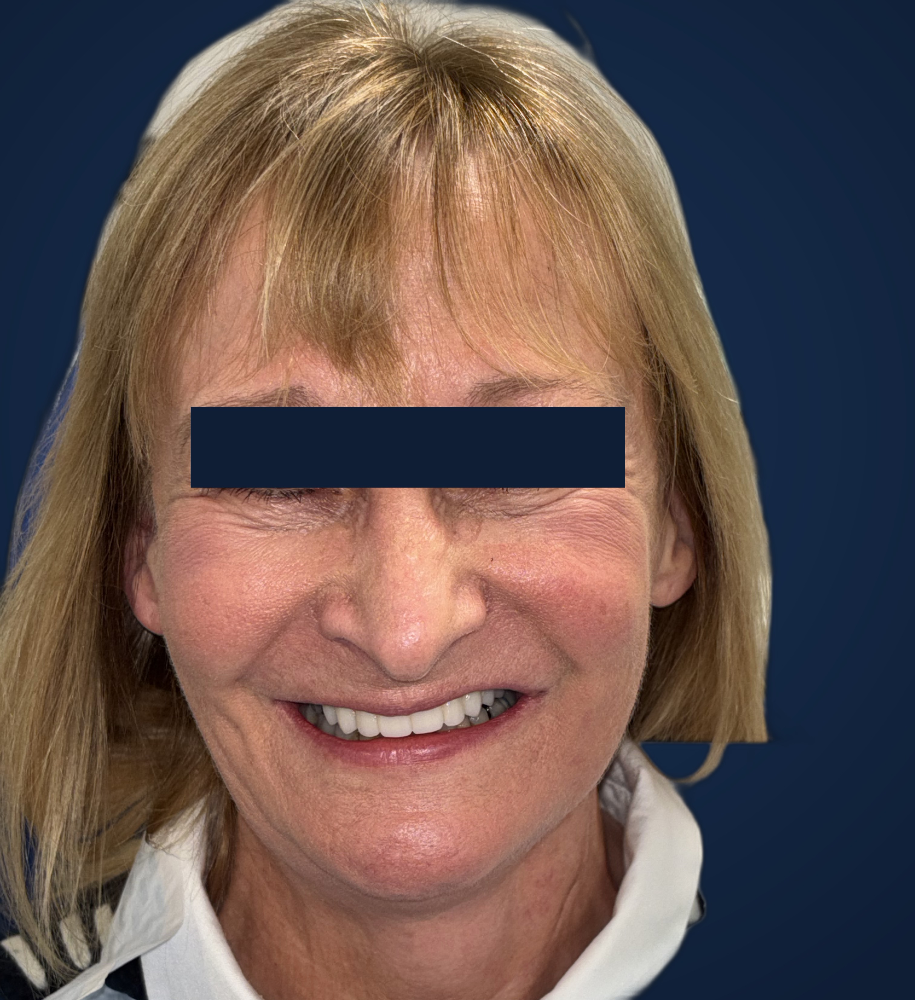 Patient outcome following ZIP-Flap reconstruction — eyes obscured for privacy