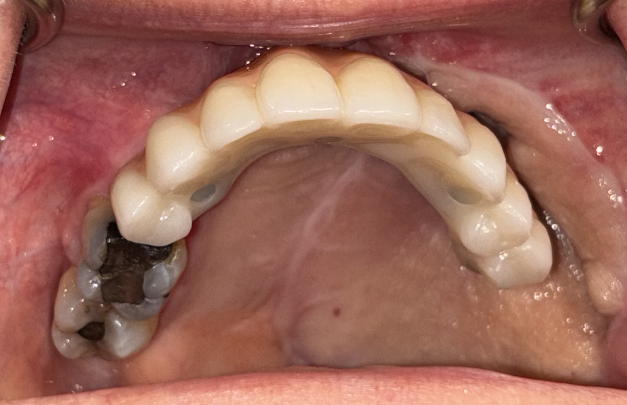 Fixed zygomatic implant-retained prosthesis following ZIP-Flap reconstruction